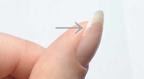 自爪の亀裂を補修する方法